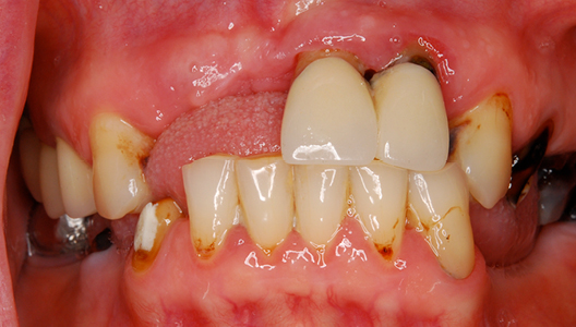 Комбинированное лечение. Костная пластика, закрытие рецессии десны и тотальное восстановление зубного ряда при помощи имплантатов и коронок из оксида циркония.