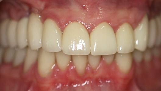Эстетическая стоматология. Восстановление верхних резцов и клыков керамическими винирами.