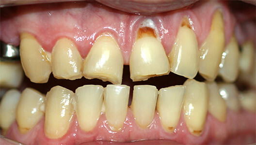 Гнатология и протезирование. Лечение хронической стираемости зубов, восстановление высоты прикуса при помощи разобщающей шины и протезирование металлокерамическими коронками.