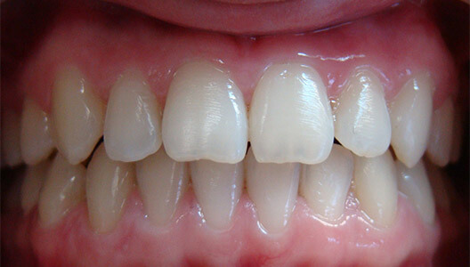 Ортодонтия. Расширение верхней челюсти при помощи небной пластины. Исправление прикуса и выравнивание зубного ряда с помощью брекет-системы.