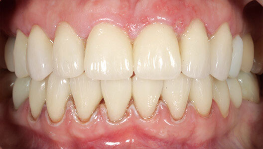 Эстетическая стоматология. Восстановление зоны улыбки винирами из диоксида циркония.