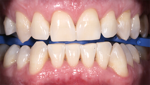 Эстетическая стоматология. Отбеливание зубов по технологии Zoom 4.