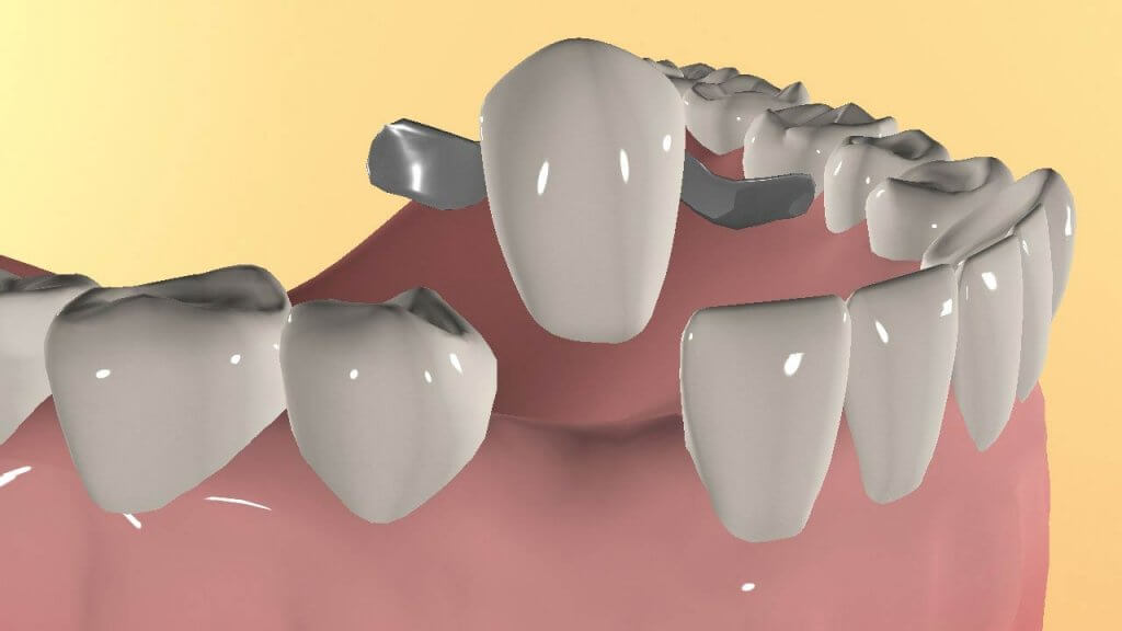 Протезирование зубов без обточки. Стоматология "Бюро 32"