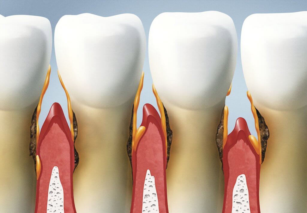 Пародонтит лечение в стоматологии