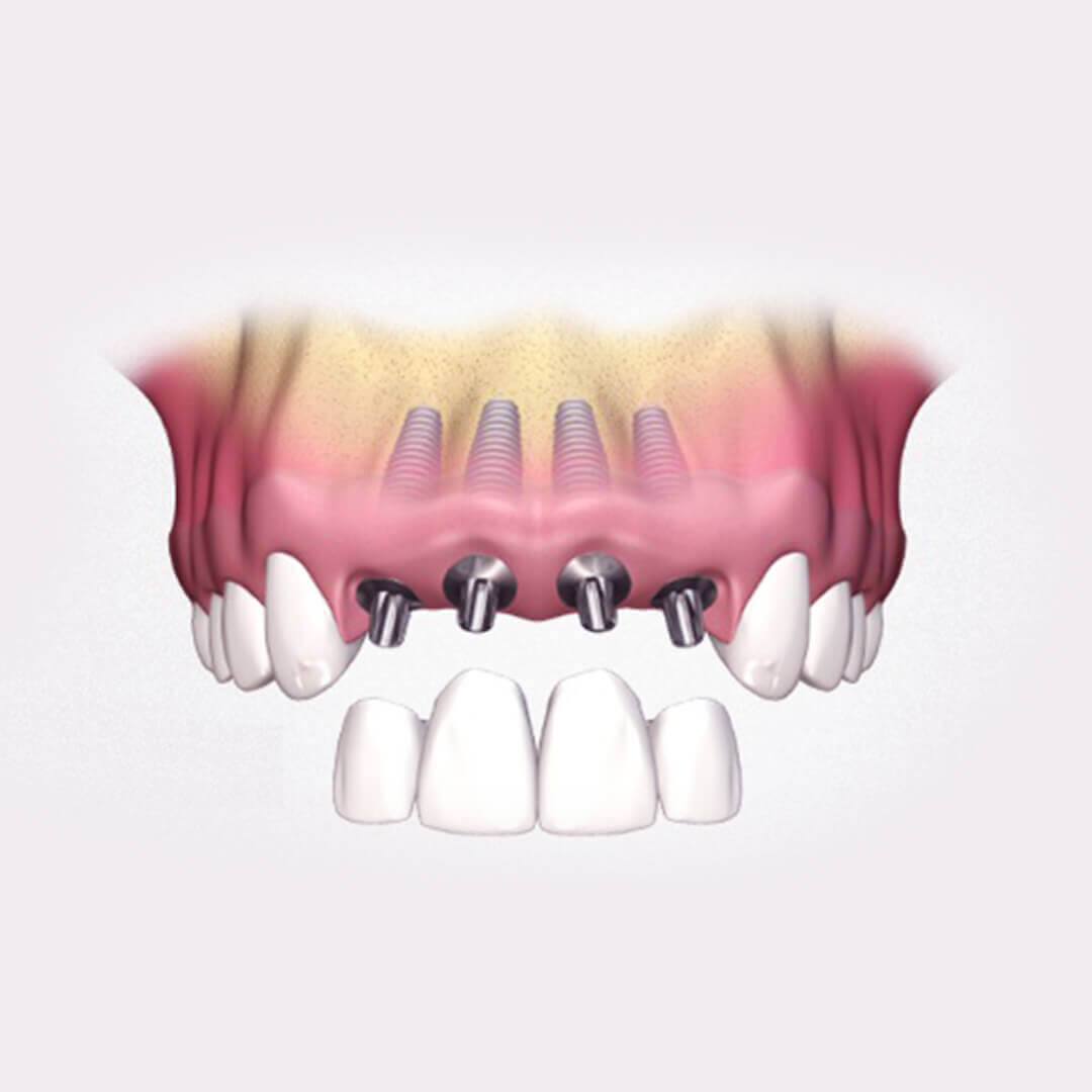 протезирование зубов мосты