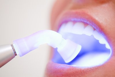 Аппаратное отбеливание зубов в Стоматологии "Бюро 32"