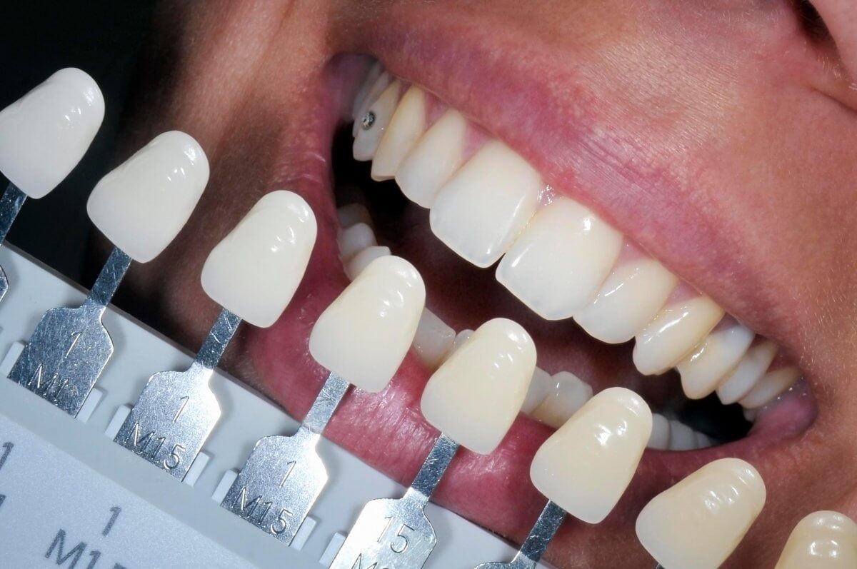 отбеливание зубов или коронки