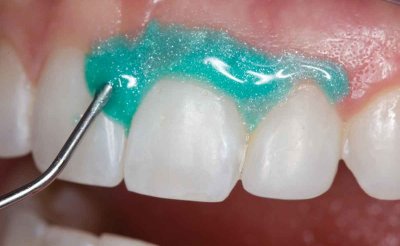 Отбеливание зубов Opalescence в Стоматологии "Бюро 32"