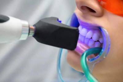 Отбеливание зубов ультрафиолетом в Стоматологии "Бюро 32"