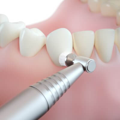 Ультразвуковая чистка зубов в Стоматологии "Бюро 32"
