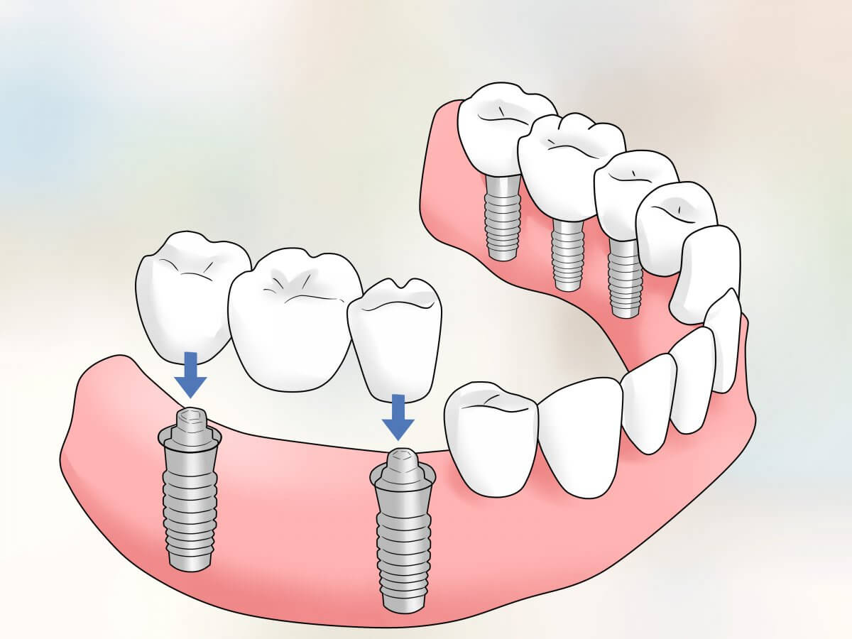 как крепятся мосты на зубы