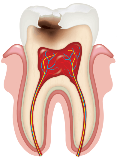 Лечение кариеса постоянных зубов в Стоматологии Бюро 32