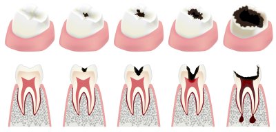 Лечение кариеса корня зуба в Стоматологии Бюро 32
