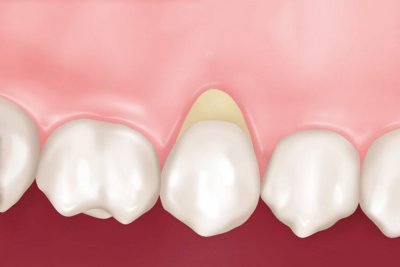 Лечение клиновидного дефекта зубов в Стоматологии Бюро 32