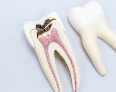 Перелечивание каналов зуба в Стоматологии Бюро 32