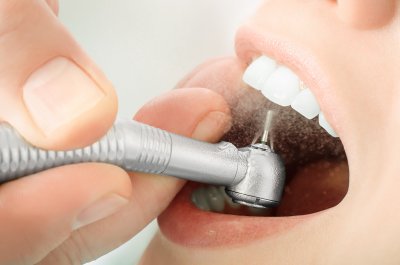 Пломбирование переднего зуба в Стоматологии Бюро 32