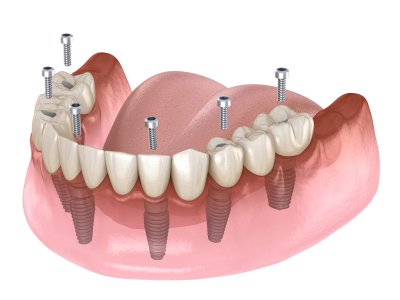 Установка имплантов при потере всех зубов в Стоматологии Бюро 32