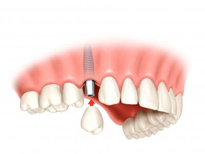 Системы имплантации зубов в Стоматологии Бюро 32