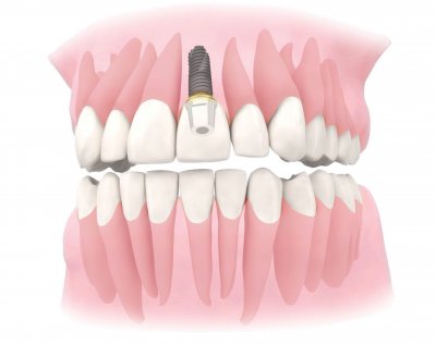 Имплантация верхних зубов в Стоматологии Бюро 32