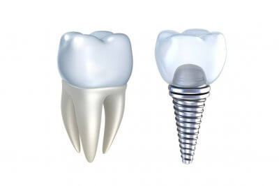 Установка титановых имплантов для зубов в Стоматологии Бюро 32
