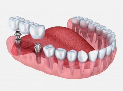 Установка имплантов на жевательные зубы в Стоматологии Бюро 32