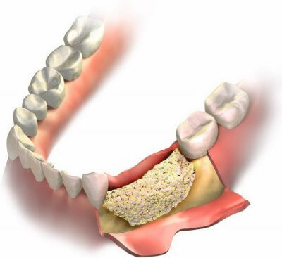 Наращивание костной ткани при имплантации зубов в Стоматологии Бюро 32