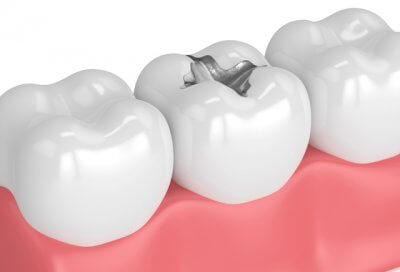 Установка различных видов пломб для зубов в Стоматологии Бюро 32