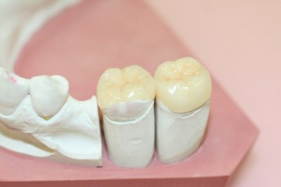 Протезирование зубов вкладками в Стоматологии Бюро 32