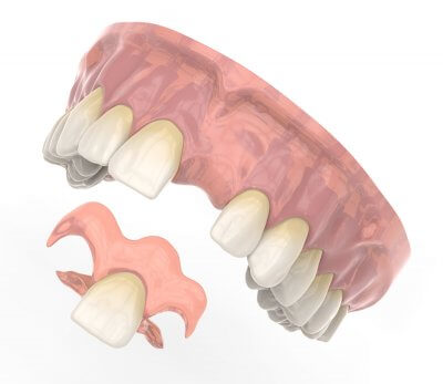 Установка временных зубных протезов в Стоматологии Бюро 32