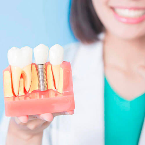 Экспресс имплантация зубов в Стоматологии Бюро 32