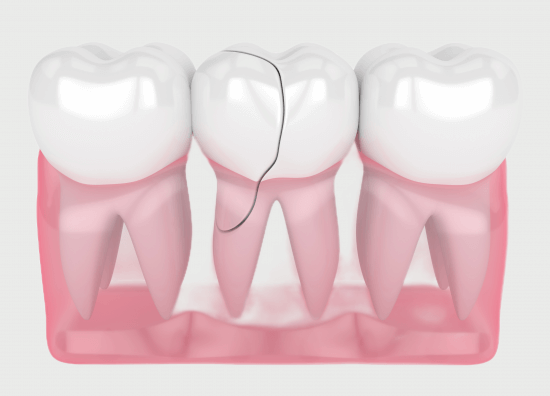 Лечение трамв зубов в Стоматологии Бюро 32