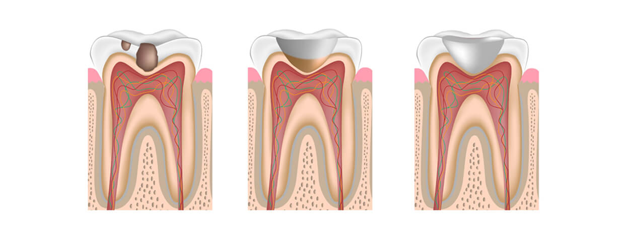 Установка пломб для зубов в Стоматологии Бюро 32