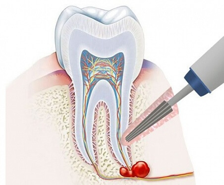Резекция верхушки корня зуба в Стоматологии Бюро 32