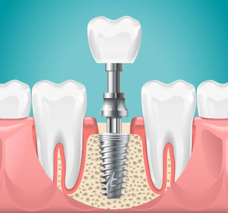 Имплантация одного зуба в Стоматологии Бюро 32