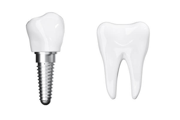 3d имплантация зубов в Стоматологии Бюро 32